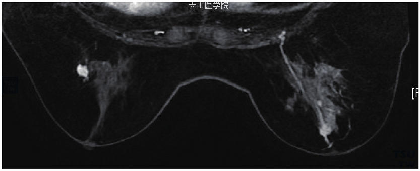 双侧乳腺癌。左乳为浸润性导管癌，右乳为导管内神经内分泌癌