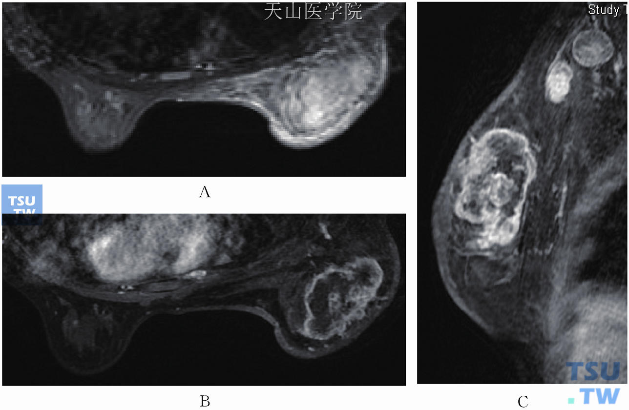 空芯针活检提示右乳浸润性导管癌。（A）T2WI右乳增大，皮肤弥漫性增厚，乳内水肿；（B）轴位增强示右乳外上明显不均匀环形强化的肿块，伴Cooper韧带增厚及强化；（C）矢状位见腋窝肿大淋巴结