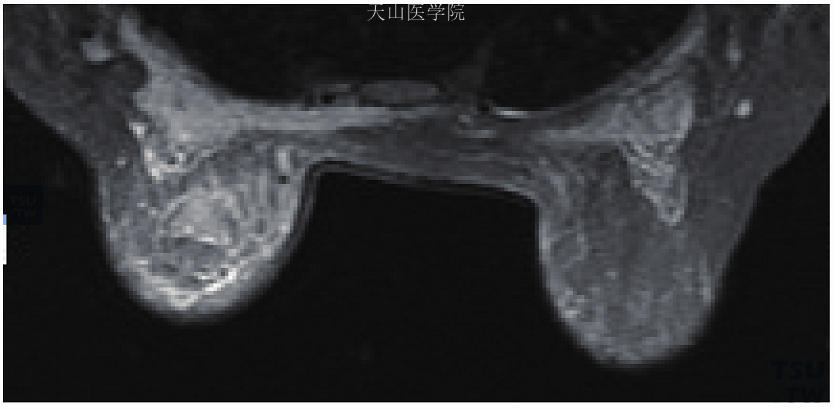 空芯针活检提示左乳腺癌。T2WI示左乳皮肤水肿，左乳内水肿伴乳后间隙及胸肌前方水肿