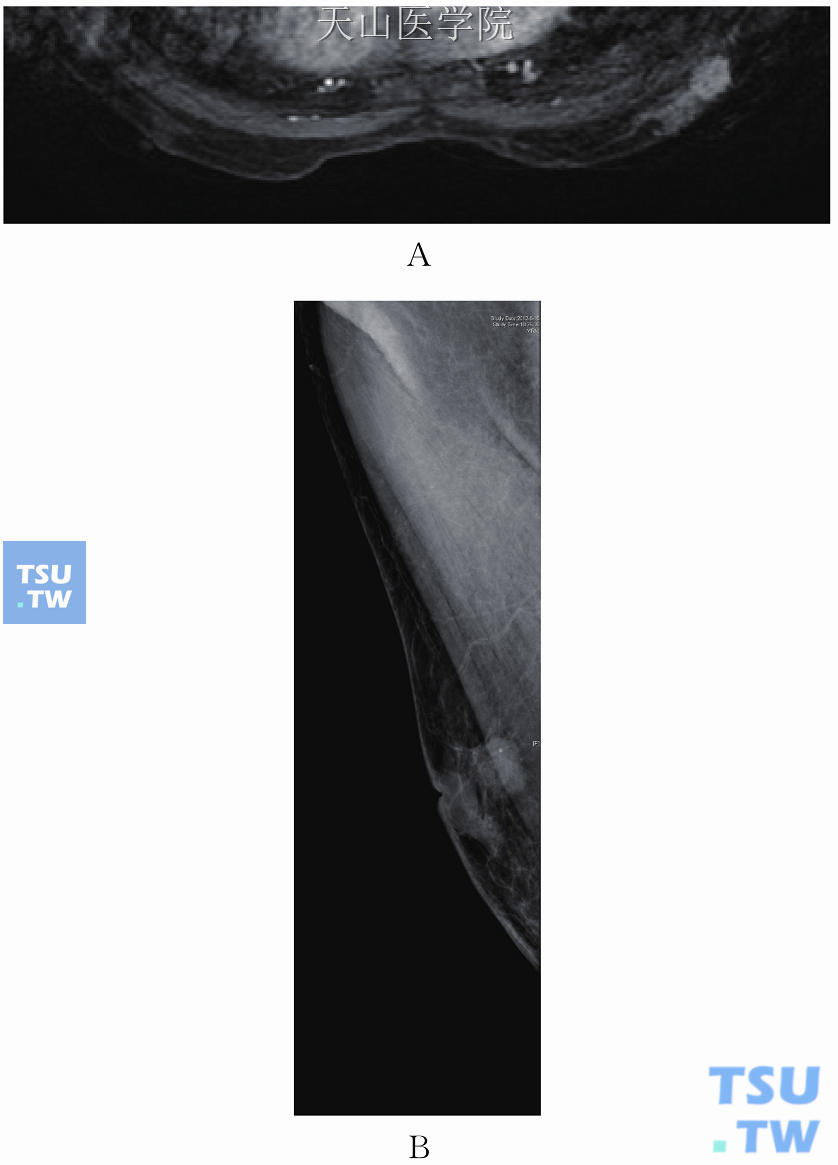 患者男性，右乳外侧浸润性导管癌，右乳头下方实性乳头状癌。（A）MRI增强轴位示右乳外侧肿块伴毛刺，右乳晕后方占位性病灶；（B）钼靶MLO位示右乳上方肿块，有分叶及毛刺伴点状钙化，右乳晕后方致密