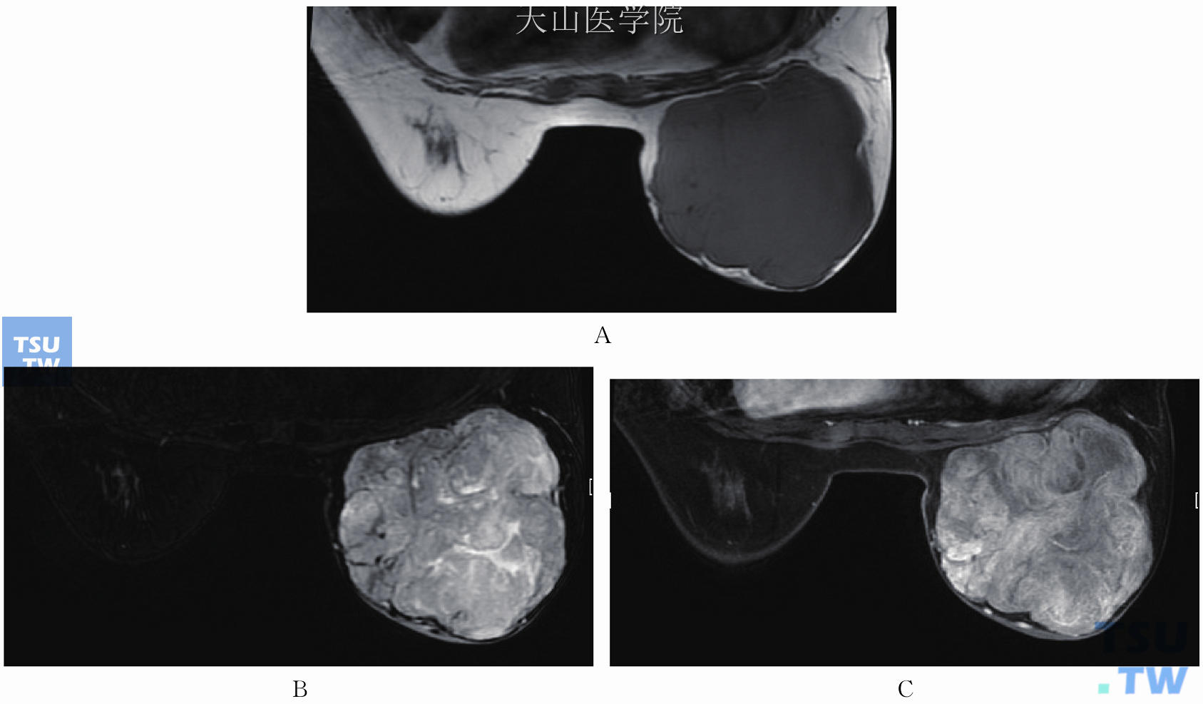 与图11-14为同一患者，右乳交界性分叶状肿瘤。（A）右乳占位性病灶，呈分叶状，T1WI低信号；（B）T2WI稍高信号内见裂隙状更高信号；（C）增强后不均匀强化