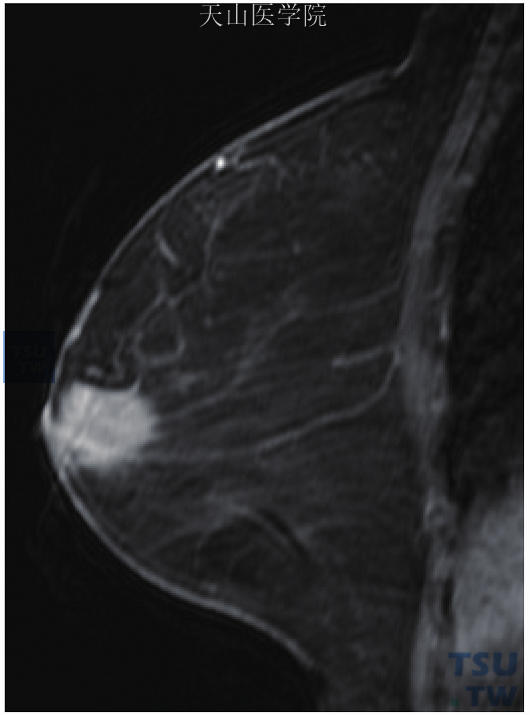右乳套细胞淋巴瘤。MRI见右乳晕后方较均匀强化的肿块