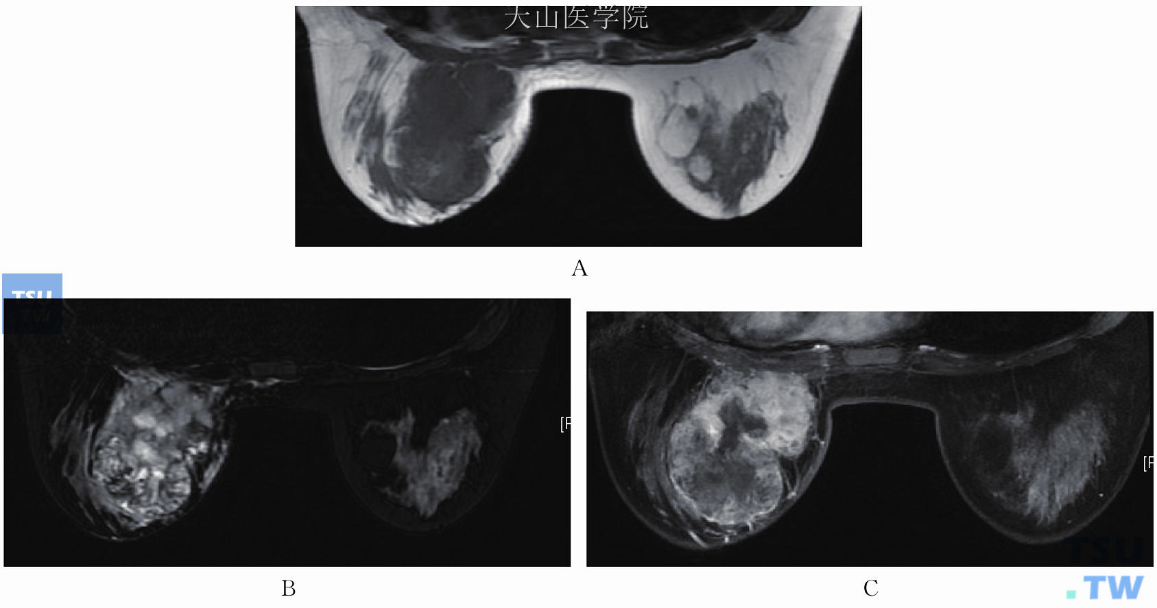 左乳未分化多形性肉瘤，左乳内下分叶状肿瘤。（A）T1WI低信号；（B）T2WI不均匀高信号；（C）增强后明显强化，坏死部分无强化