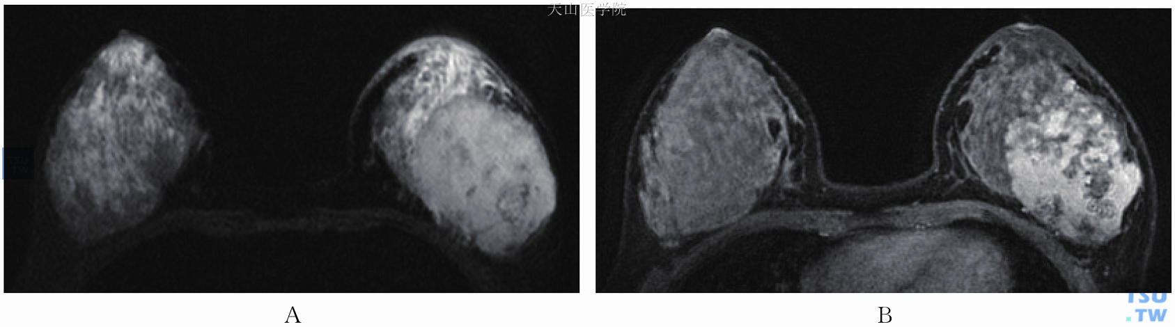左乳血管肉瘤，左乳晕后方类圆形肿块。（A）T2WI高信号，其内见条索状低信号，前方导管扩张；（B）增强后明显强化，伴延迟强化，肿块边界欠清
