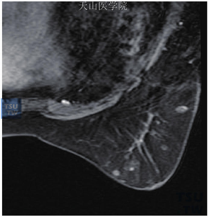 左乳浸润性导管癌术后，右乳皮下多发转移