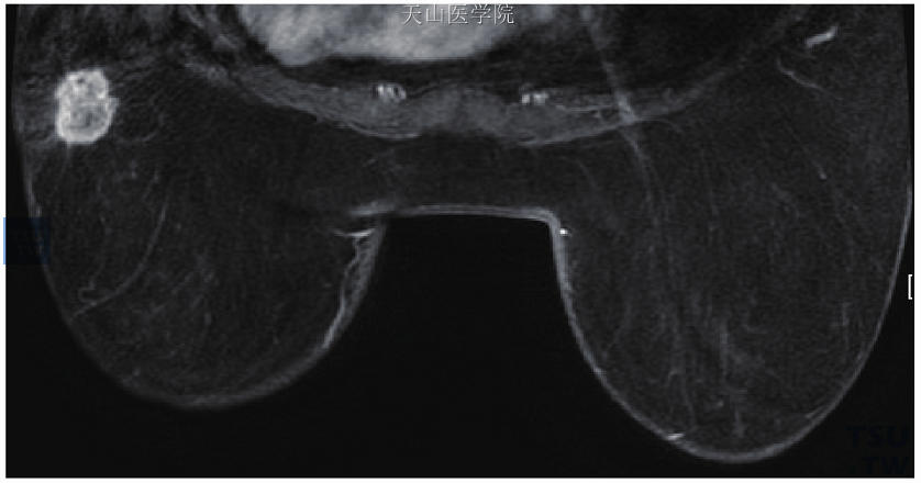 直肠癌术后5年，左乳转移性腺癌。左乳外下肿块，环形强化，有毛刺及浅分叶，类似于浸润性癌