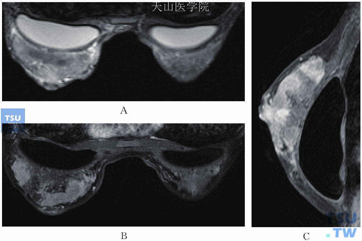 左乳晕下方浸润性导管癌，另见乳内组织大量异物伴多核巨细胞反应。两乳假体植入术后，左乳头凹陷，（A）T2WI左乳乳内不均匀高信号；（B、C）增强后肿块异常强化伴毛刺，乳内弥漫性不均匀强化