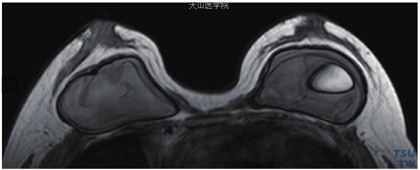 T1WI示左乳植入体内见发丝样低信号，右乳植入体内见类圆形高信号，提示植入体囊内破裂可能