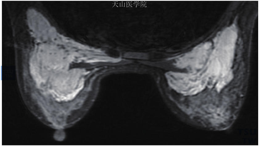 两乳假体植入术后。双侧乳后间隙及胸大肌内见填充物，提示植入体囊外破裂、渗漏