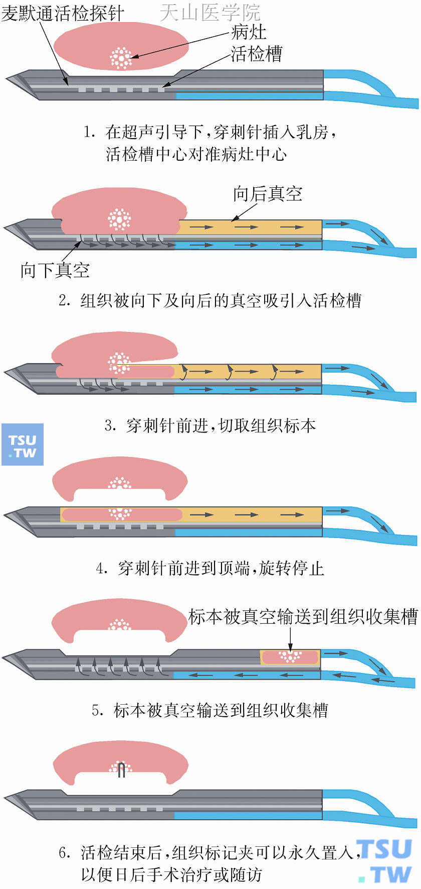 超声引导下的粗针活检示意