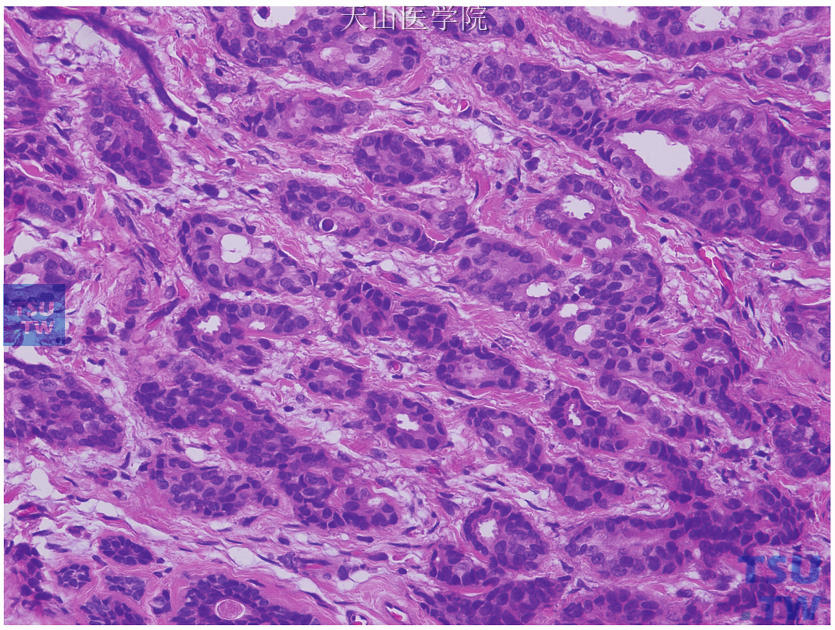 浸润性导管癌I级，肿瘤细胞低度异型，形成大量腺管