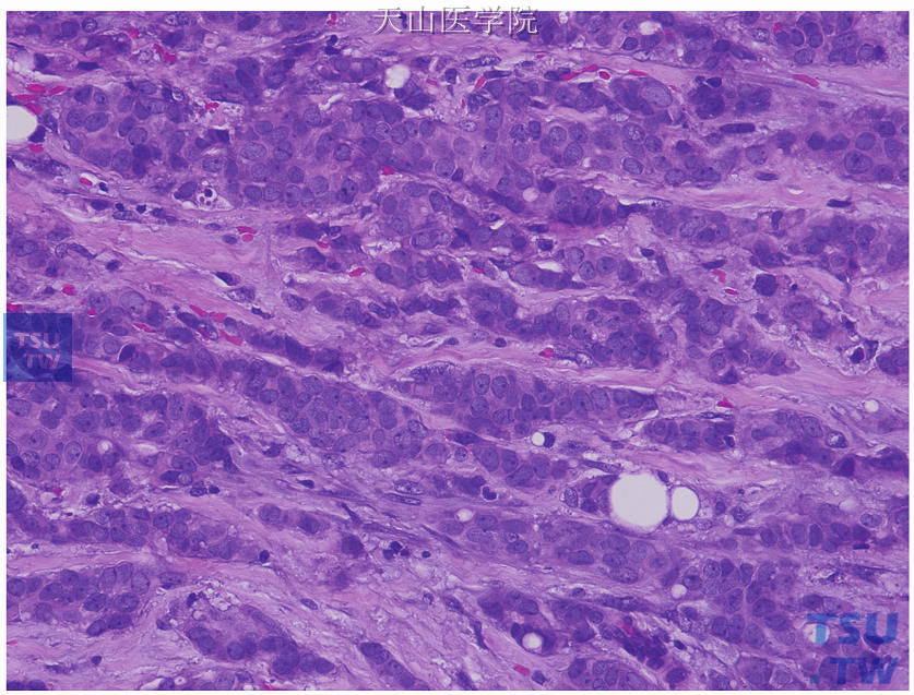 浸润性导管癌II级，肿瘤细胞中度异型，形成结构较复杂的腺管