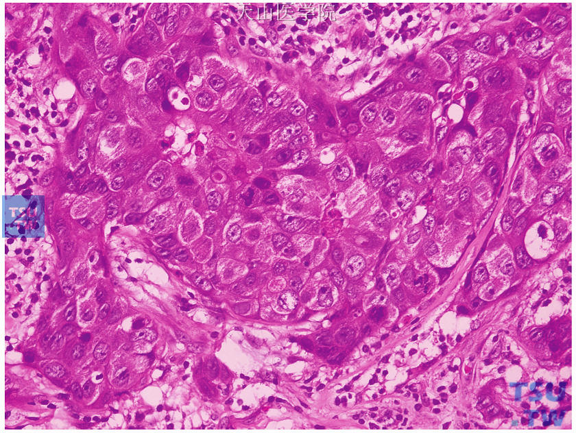 浸润性导管癌III级，肿瘤细胞高度异型，核仁明显，核分裂象多见，呈实性生长