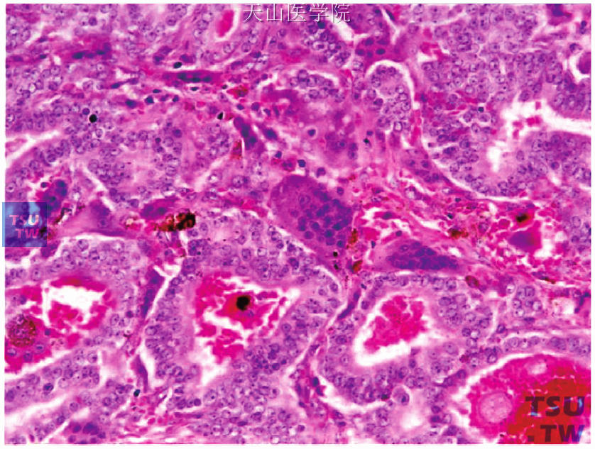 乳腺浸润性导管癌（非特殊型）及其亚型