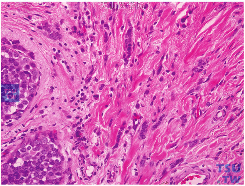 经典型浸润性小叶癌，肿瘤细胞呈单排列兵样浸润性生长，左侧见小叶原位癌结构