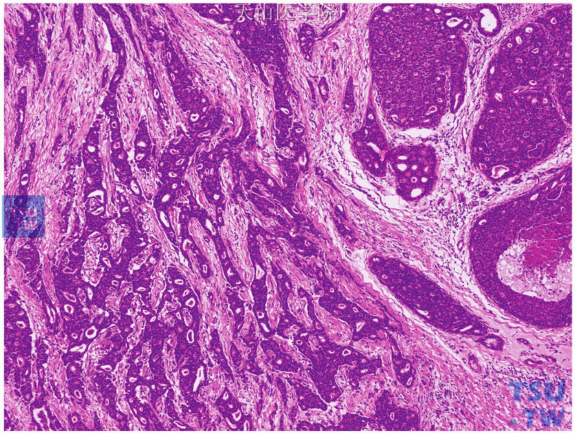 浸润性筛状癌，不规则筛状结构呈浸润性生长，右侧见筛状型导管原位癌