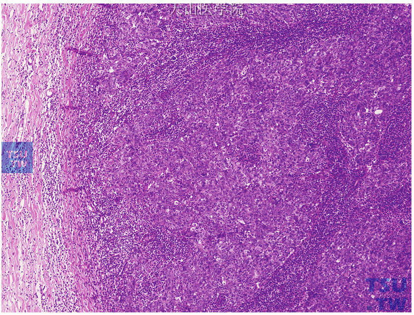 髓样癌，低倍镜示肿瘤边界清楚，肿瘤细胞实性片状分布，伴多量淋巴细胞浸润