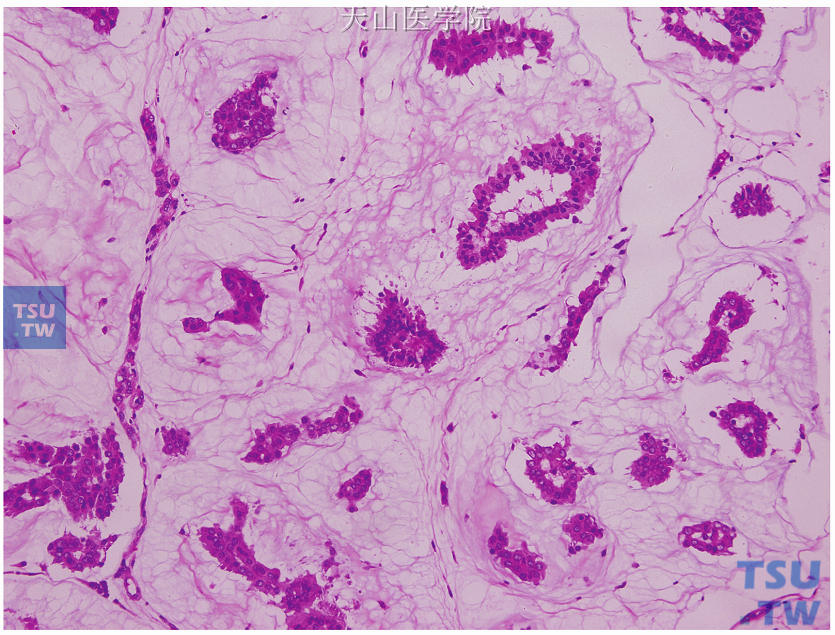 A型黏液腺癌，肿瘤细胞排列成小梁状、缎带样或花环样，含有大量的细胞外黏液