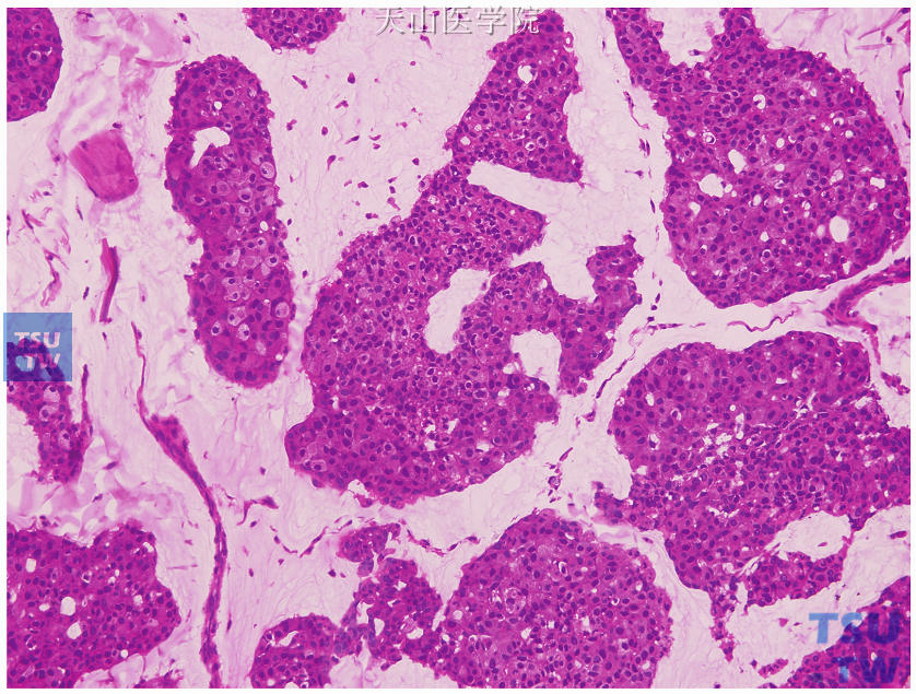 B型黏液腺癌，黏液湖内肿瘤细胞较丰富，呈片状、巢状排列