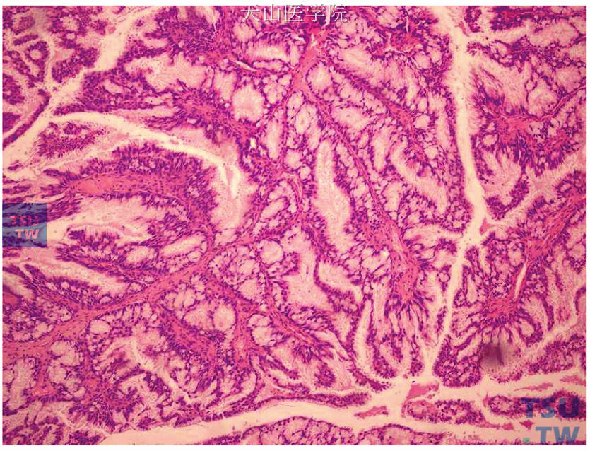 柱状细胞黏液癌，疏密不均的腺体，由单层高柱状黏液上皮构成