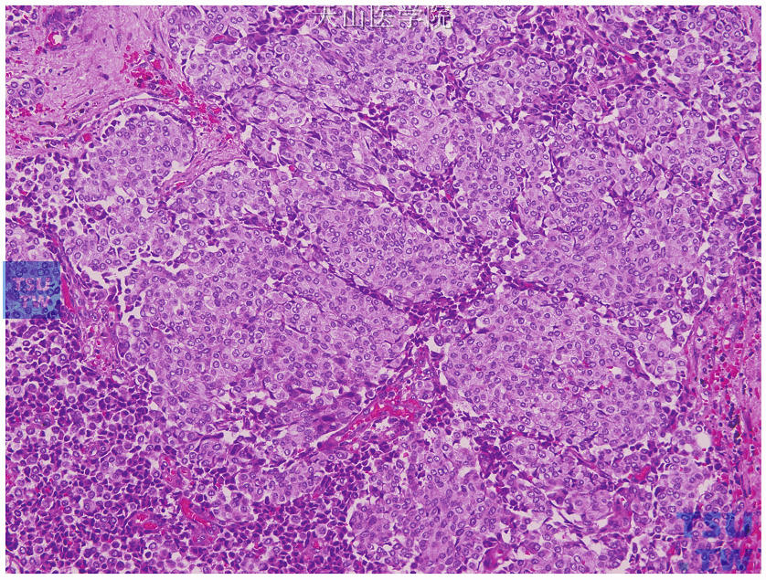 实体型神经内分泌癌，肿瘤细胞呈实性巢状排列，其间有纤维血管分隔