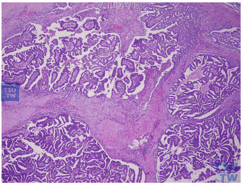 浸润性乳头状癌，肿瘤组织由大量乳头状结构组成，呈浸润性生长