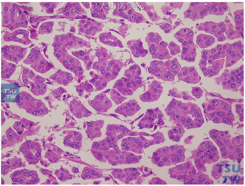 浸润性微乳头状癌，微乳头状结构，细胞核呈中级别，核仁较清楚