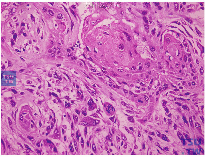 鳞癌伴有梭形细胞化生，见鳞状细胞癌和梭形细胞成分，细胞有明显异型，并见病理性核分裂象