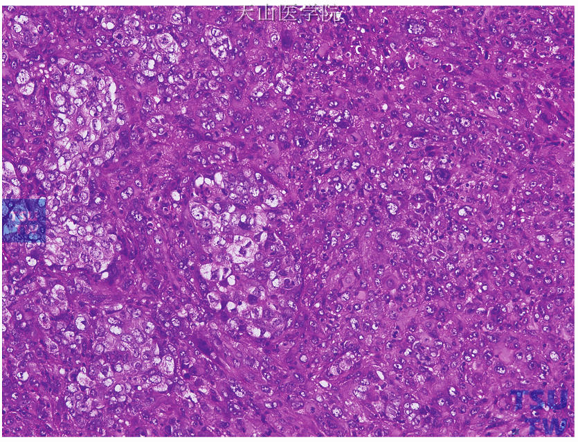 癌肉瘤，左侧见低分化癌成分，右侧见肉瘤成分