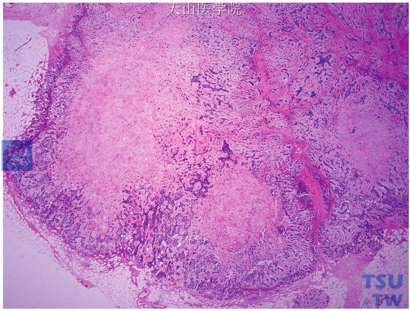 产生基质的癌，肿瘤呈结节状，边界较清，周边区肿瘤细胞较丰富