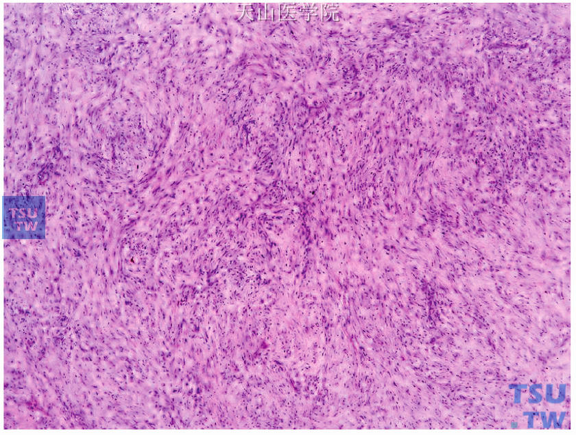 低度恶性纤维瘤病样梭形细胞癌，梭形细胞呈纤维瘤病样生长方式