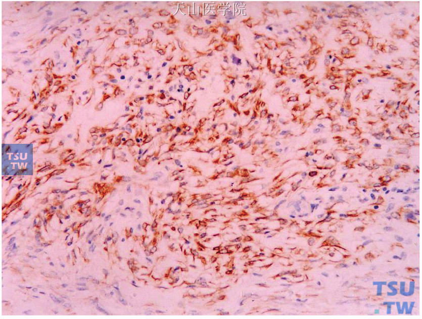 低度恶性纤维瘤病样梭形细胞癌，梭形细胞表达CK