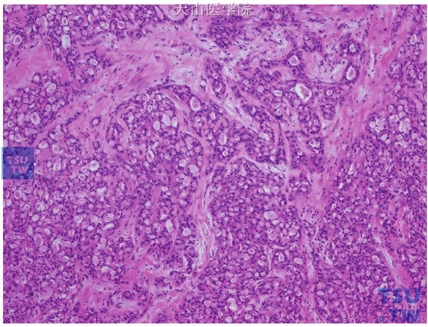 分泌性癌，肿瘤组织呈微囊状（蜂窝状）结构，微囊内见分泌物