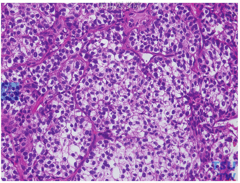 富于糖原的透明细胞癌，肿瘤细胞为多边形，胞质丰富、透亮