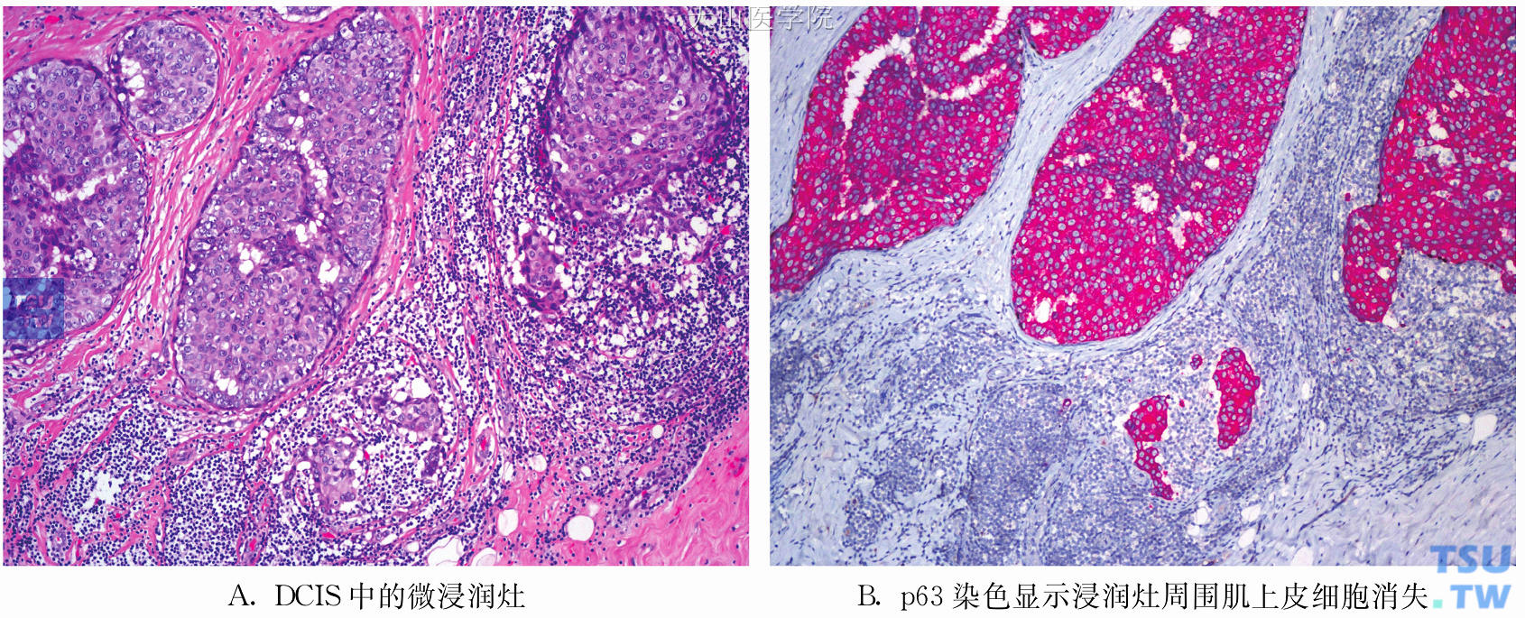 DCIS伴微浸润