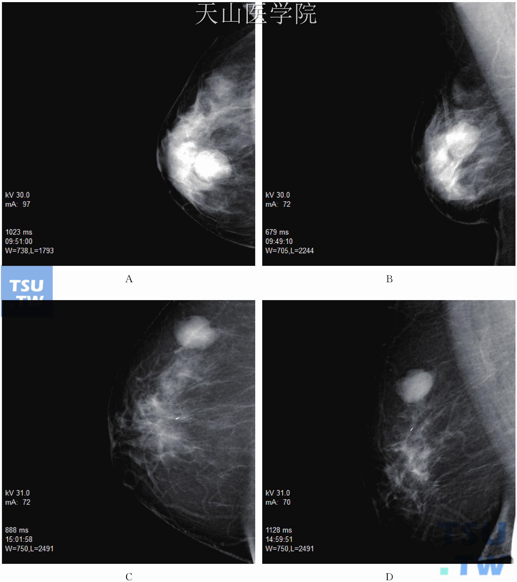 乳腺分叶状肿瘤的钼靶X线表现