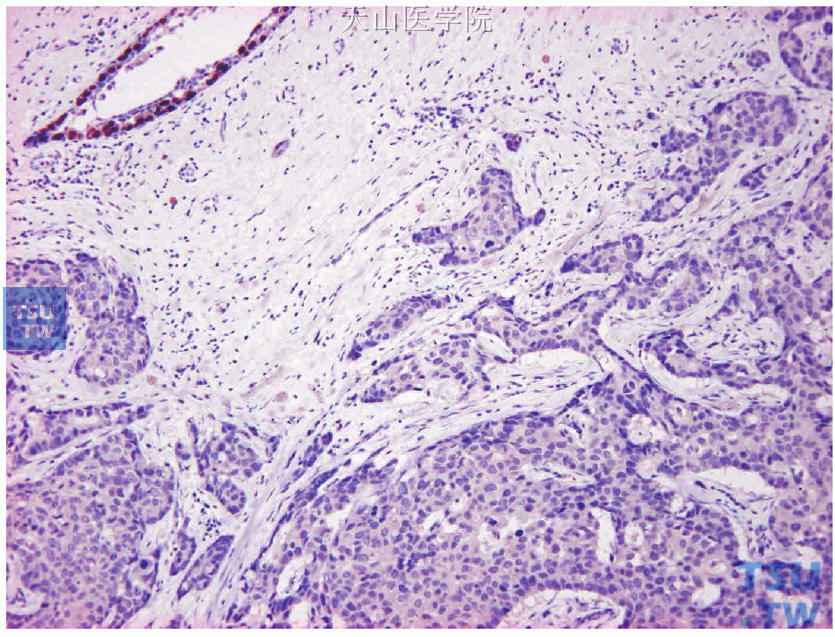 被检测肿瘤组织的瘤旁正常乳腺导管作为阳性内对照（左上角的正常乳腺导管腺上皮细胞ER阳性，癌细胞阴性）