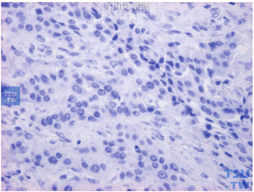 符合质量控制的ER肿瘤组织作为阴性外对照（图19-2肿瘤组织的连续切片，以PAS代替ER抗体，结果癌细胞阴性）