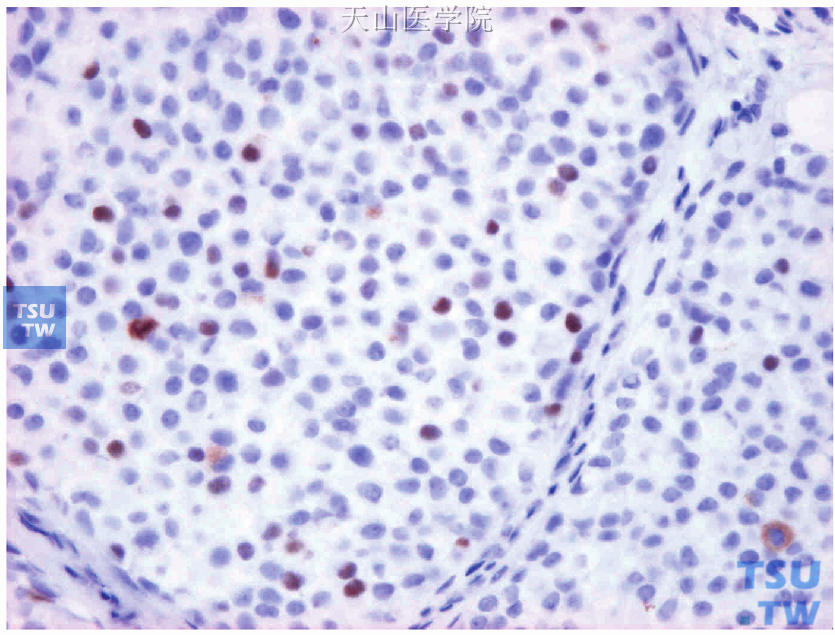 ER阳性细胞约占10%，弱-中等着色