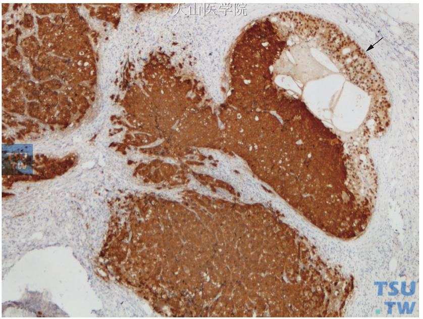 图19-9连续切片的ER免疫组化检测，浸润性癌成分及部分导管内癌成分阴性（细胞质着色），仅极少部分导管内癌成分（箭头所示）阳性（核着色）