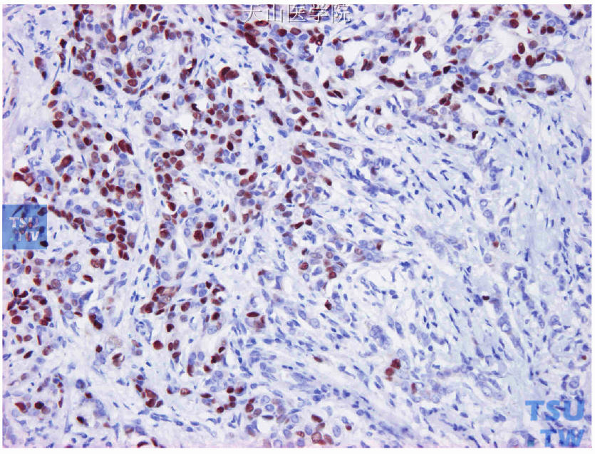 图19-11连续切片的ER免疫组化染色，肿瘤中央纤维化明显部分的肿瘤细胞（图右侧）阴性