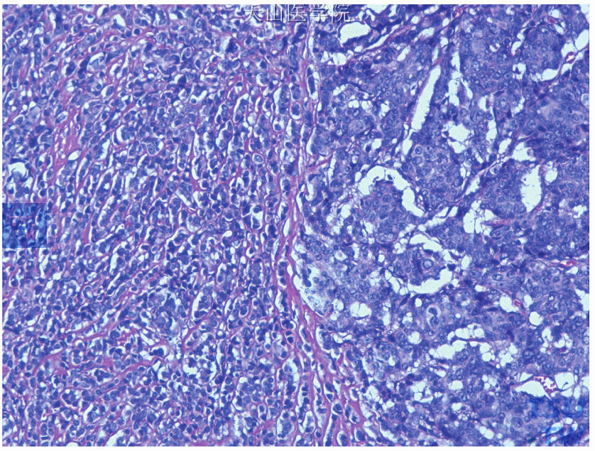 混合型癌，经典型浸润性小叶癌（左侧）伴非特殊型浸润性导管癌（右侧）