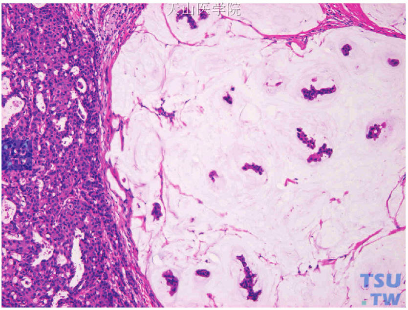 混合型癌，非特殊型浸润性导管癌（左侧）伴纯型黏液癌（右侧）