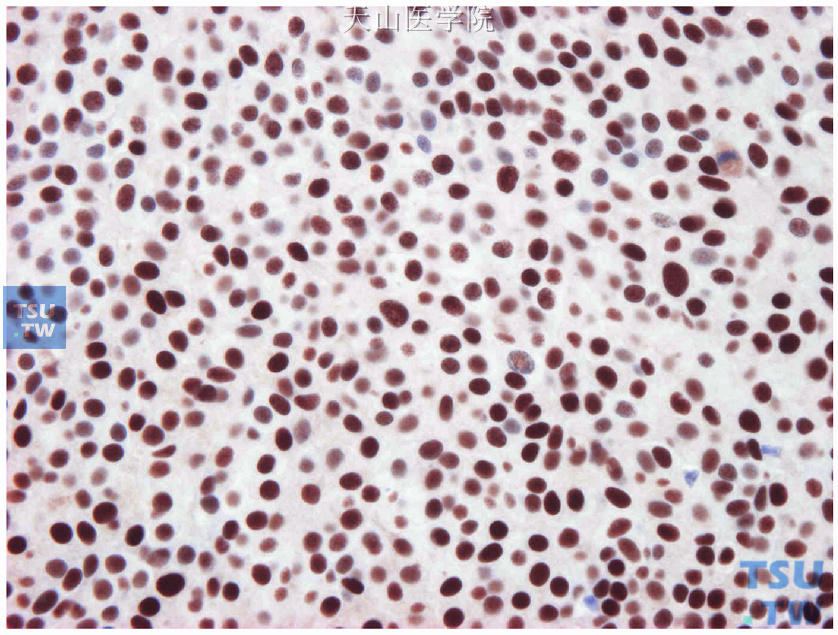图19-15连续切片的ER免疫组化检测，非特殊型浸润性导管癌的阳性细胞>90%，中-强着色