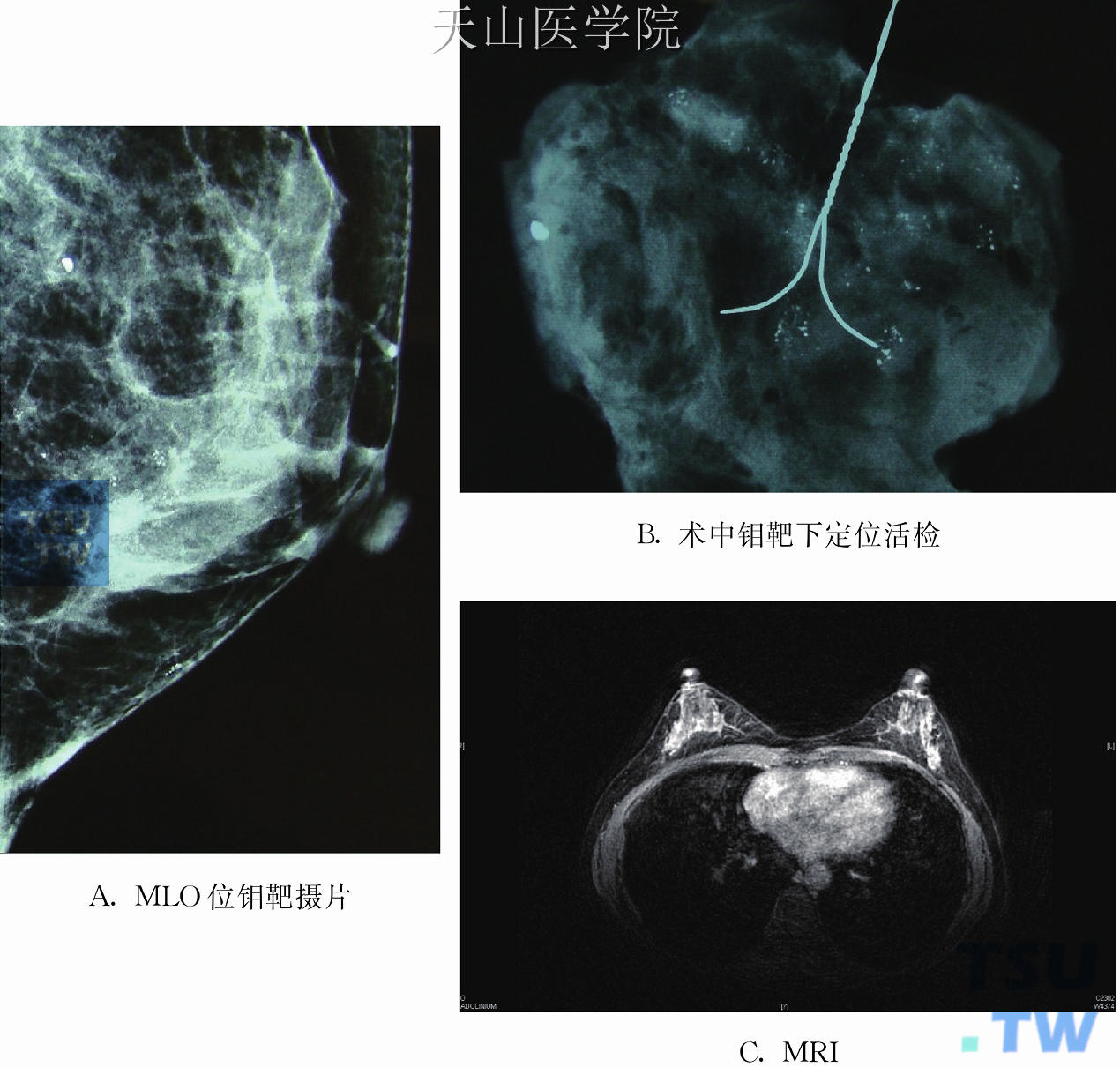 乳腺导管原位癌钼靶摄片及MRI表现
