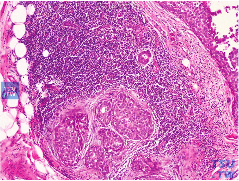 导管原位癌伴微浸润，少量肿瘤细胞成簇状出现于导管原位癌周围富于淋巴细胞的间质内