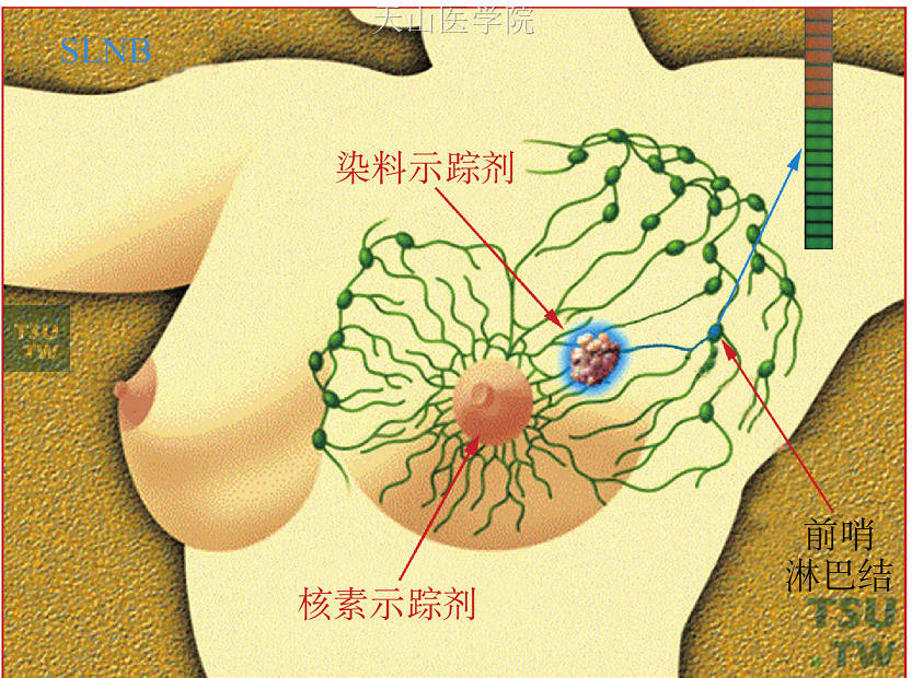 染料注射于肿瘤周围皮下，放射性核素示踪剂注射于乳头乳晕下，结果两者标记为同一个前哨淋巴结