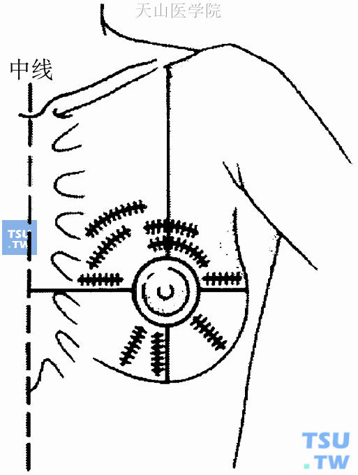 NSABP推荐保乳手术肿瘤切除的切口设计