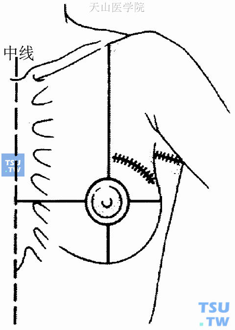 NSABP推荐保乳手术中腋窝淋巴结清扫与乳腺肿瘤切除以两切口为宜