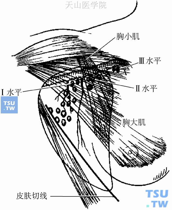 腋窝淋巴结分组图片